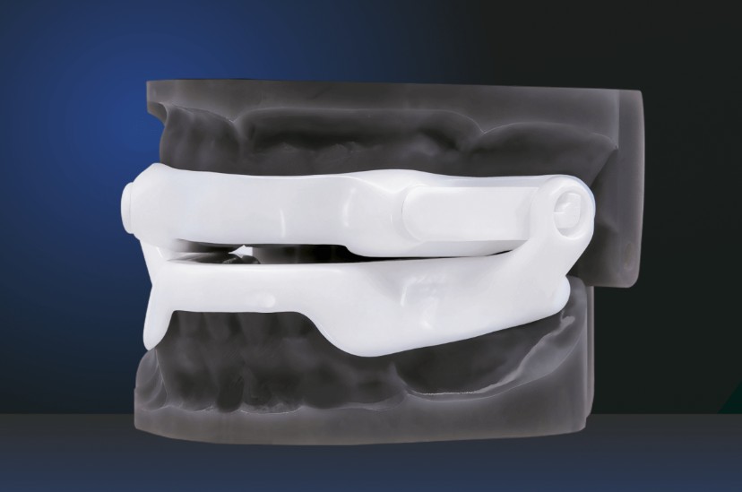 Custom oral appliance for sleep apnea