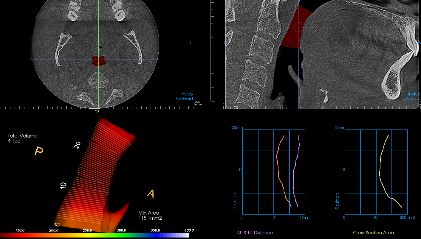 CBCT airway analysis showing volume and cross-sectional area